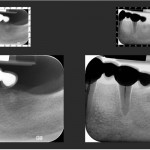 eu-implant-dentar-punte-dentara-extensie